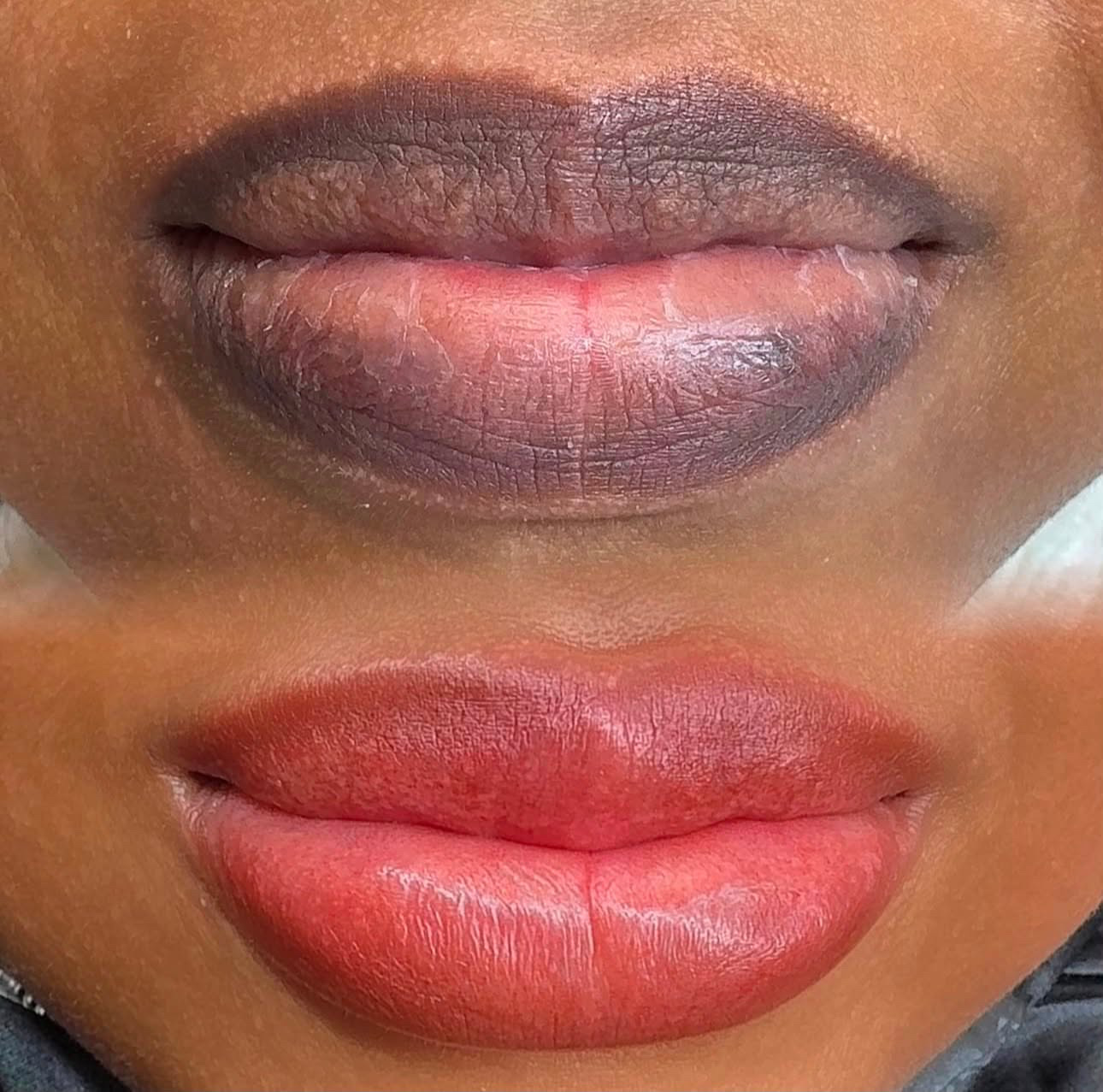 Lip neutralisation cosmetic tattoo result for uneven lip tone in Braybrook, Melbourne